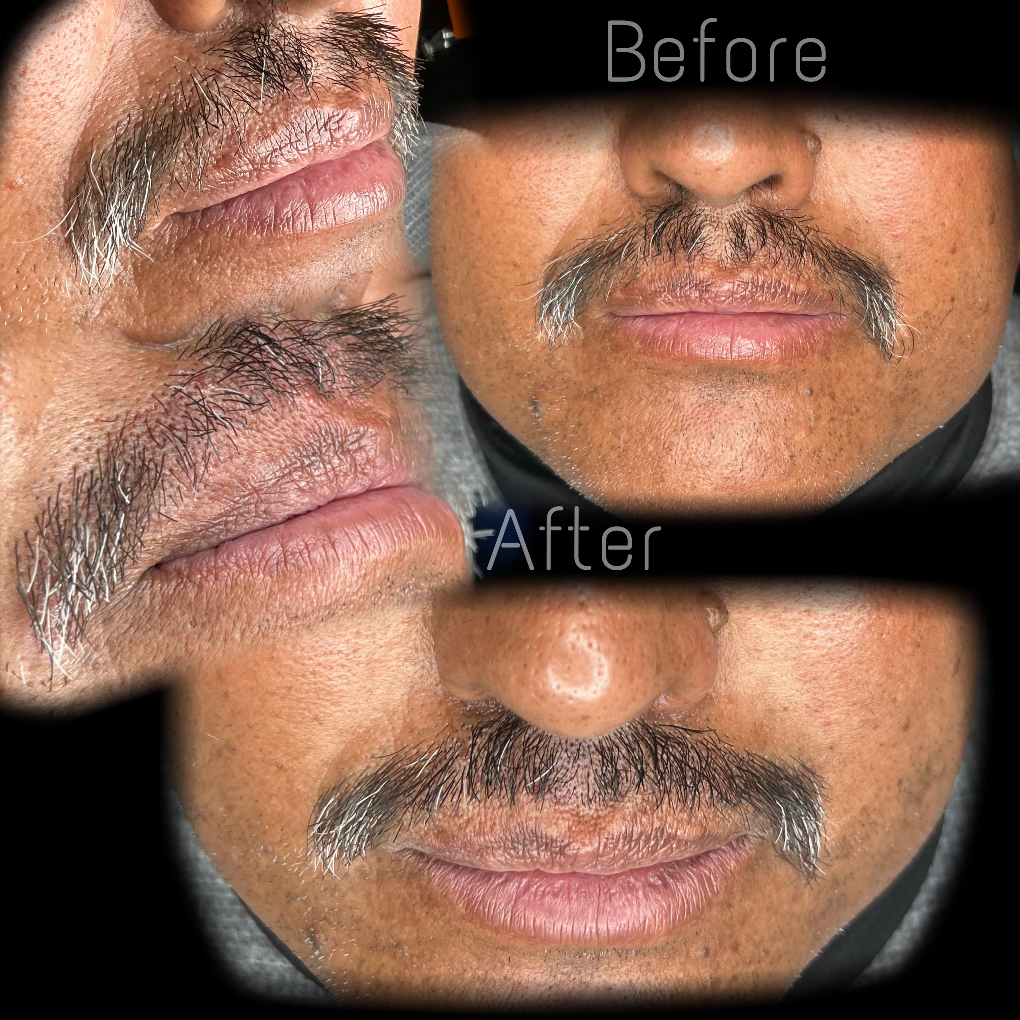 Mustache Micro-pigmentation (BMP)
