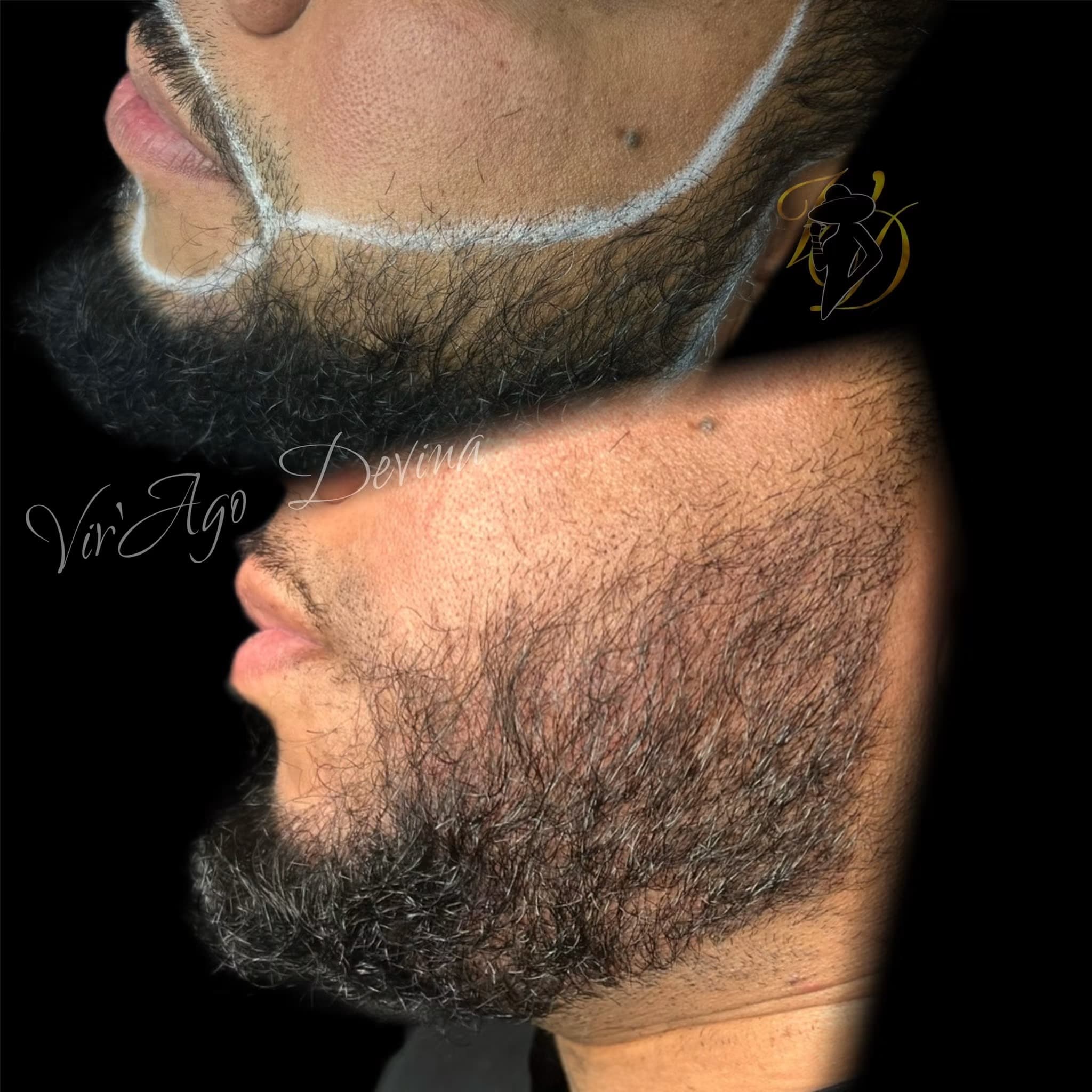 Beard Micro-pigmentation